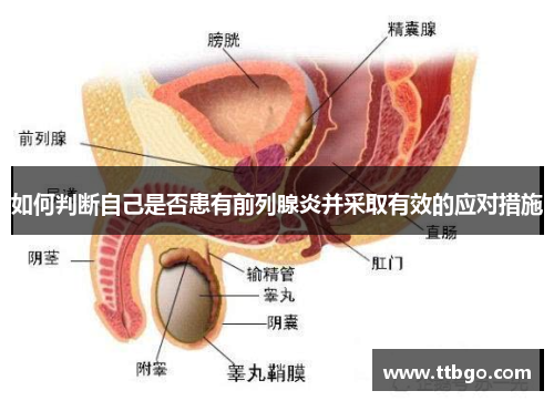 如何判断自己是否患有前列腺炎并采取有效的应对措施